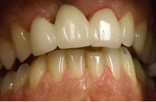 Smile Gallery - After