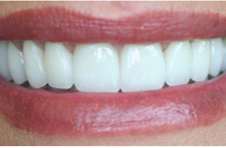 Smile Gallery - After