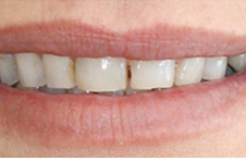 Smile Gallery - Before