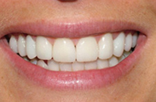 Smile Gallery - After