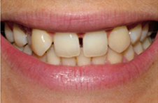 Smile Gallery - Before