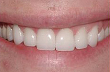 Smile Gallery - After