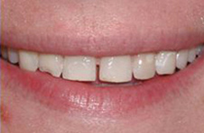 Smile Gallery - Before