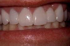 Smile Gallery - After