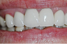 Smile Gallery - After