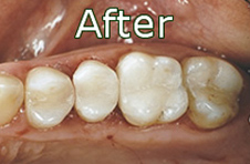 Smile Gallery - After