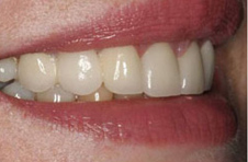 Smile Gallery - After