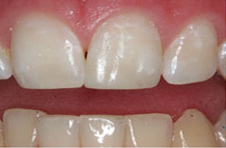 Smile Gallery - After