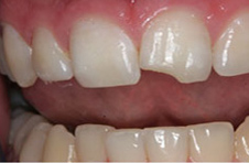 Smile Gallery - Before