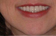 Smile Gallery - After