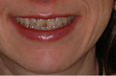 Smile Gallery - Before