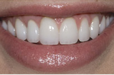 Smile Gallery - After