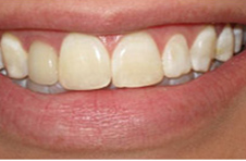 Smile Gallery - Before