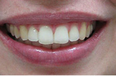 Smile Gallery - After