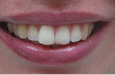 Smile Gallery - Before