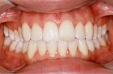 Smile Gallery - After