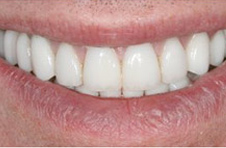 Smile Gallery - After