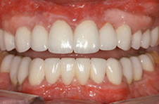 Smile Gallery - After