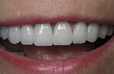 Smile Gallery - After