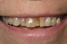 Smile Gallery - Before