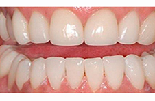 Smile Gallery - After