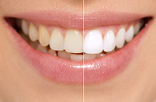 Smile Gallery - Before