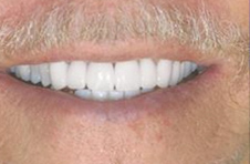 Smile Gallery - After