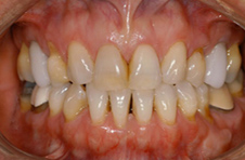 Smile Gallery - Before