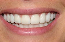 Smile Gallery - After