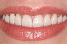 Smile Gallery - After