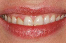 Smile Gallery - Before