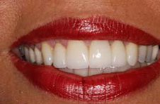 Smile Gallery - After