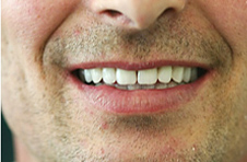 Smile Gallery - After