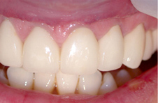 Smile Gallery - After