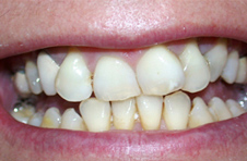 Smile Gallery - Before