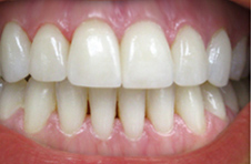 Smile Gallery - After