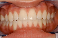 Smile Gallery - After