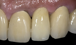 Smile Gallery - After