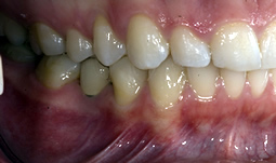 Smile Gallery - After