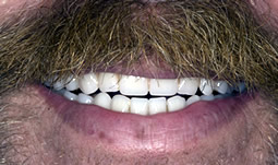 Smile Gallery - After