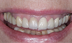 Smile Gallery - Before