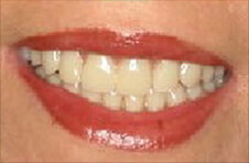 Smile Gallery - After