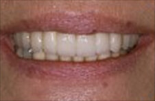 Smile Gallery - After