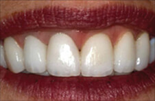 Smile Gallery - After