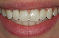 Smile Gallery - After
