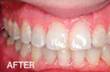 Smile Gallery - After