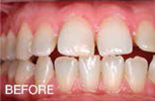 Smile Gallery - Before