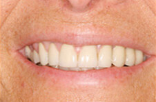 Smile Gallery - After