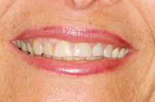 Smile Gallery - Before