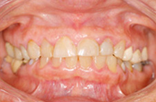 Smile Gallery - Before